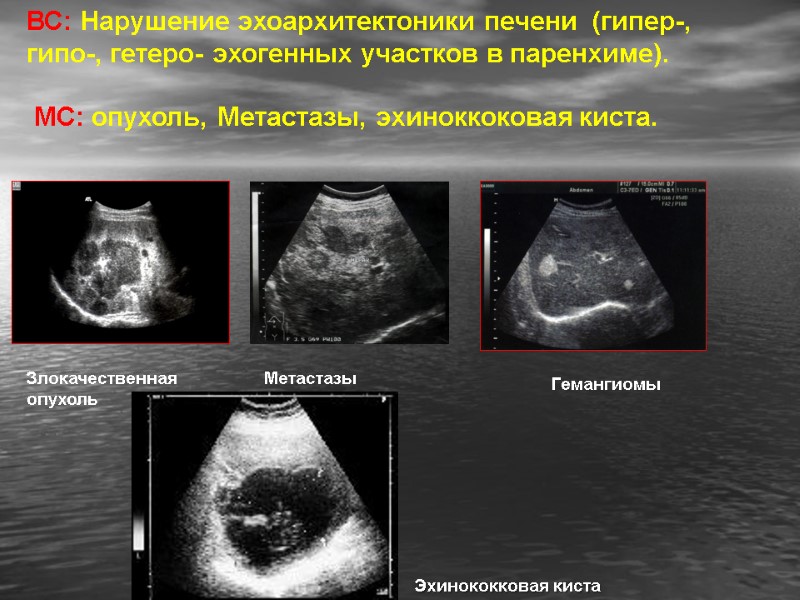 ВС: Нарушение эхоархитектоники печени  (гипер-, гипо-, гетеро- эхогенных участков в паренхиме).  